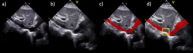 congestive heart failure